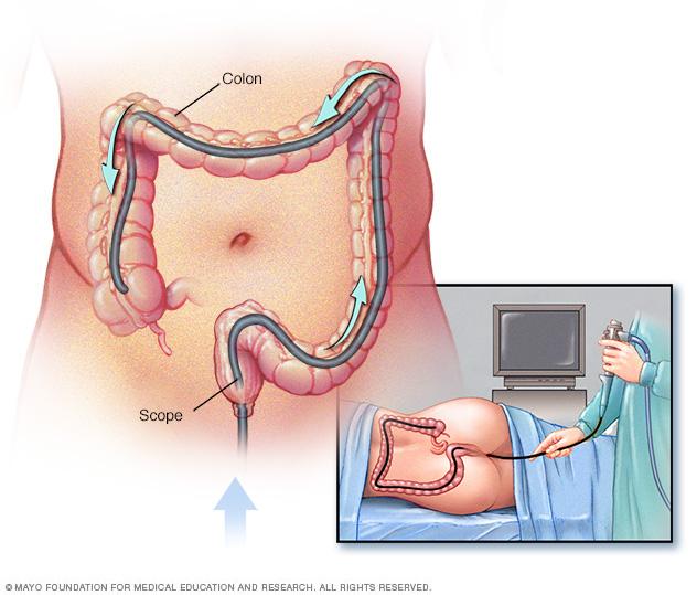 Colonoscopy